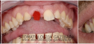Fiksna protetika – metal – keramika