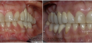 Fiksna protetika – metal – keramika