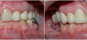 Fiksna protetika – metal – keramika