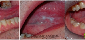 Leukoplakija uzrokovana galvanizmom