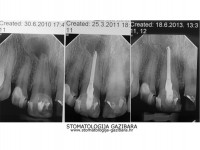 LIJEVO: 4a liječenje granuloma ,početno stanje<br />
SREDINA: 4b stanje nakon 9 mjeseci<br />
DESNO: 4c stanje nakon 3 godine, granuloma više nema !