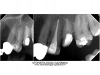 LIJEVO: 3a  prije revizije punjenja,jednokorijenski zub<br />
DESNO: 3b  nakon završetka terapije