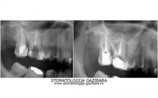 LIJEVO: 2a revizija punjenja korijenskih kanala,višekorijenski zubi        <br />
DESNO: 2b nakon završetka terapije