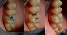 amalgamski ispun - karijes ispod starog amalgama - novi kompozitni ispun