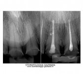 LIJEVO: 1a početno stanje,prednji zubi - DESNO: 1b nakon završetka terapijee